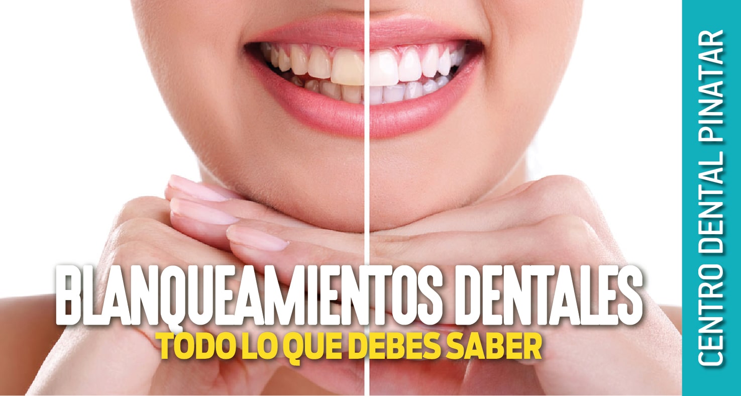 Blanqueamiento Dentales Todo Lo Que Debes Saber - Centro Dental Pinatar