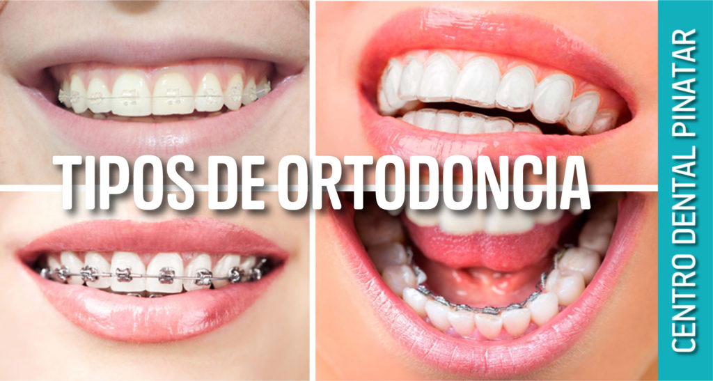 Tipos De Ortodoncia ¿Cuál Debo Elegir? - Centro Dental Pinatar